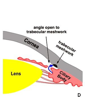 Open angle following laser iridotomy 